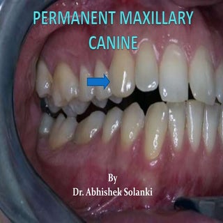 Permanent  Maxillary & Mandibular C...