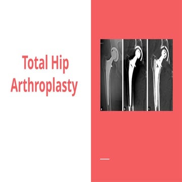 Physiotherapy Rehab After Total Hip Replacement | PPTX