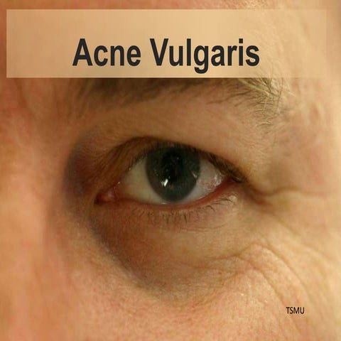 acne vulgaris