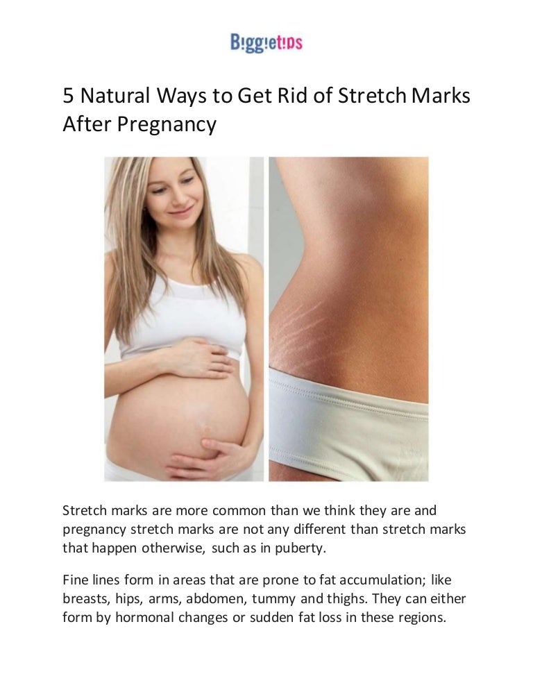5 Natural Ways To Get Rid Of Stretch Marks After Pregnancy