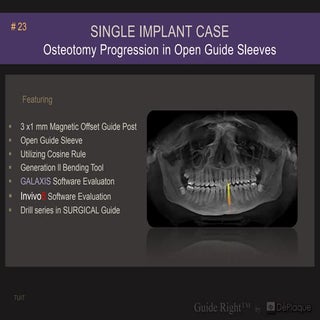 5 single implant case osteotomy prg...