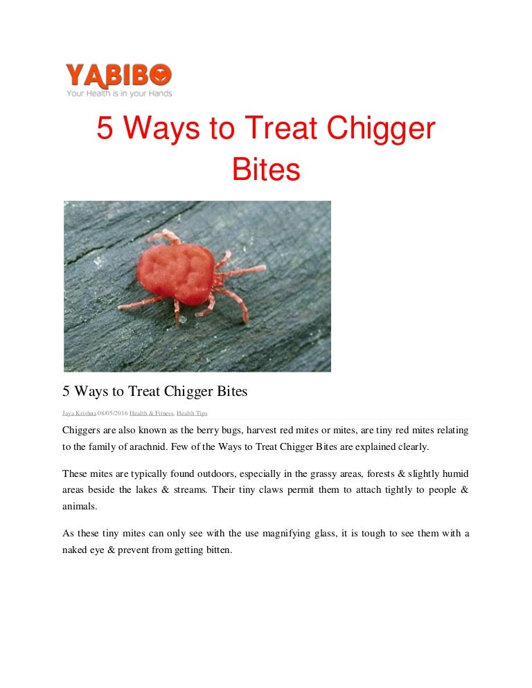 5 ways to treat chigger bites