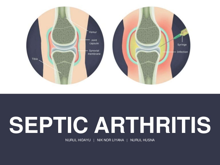 Septic Arthritis