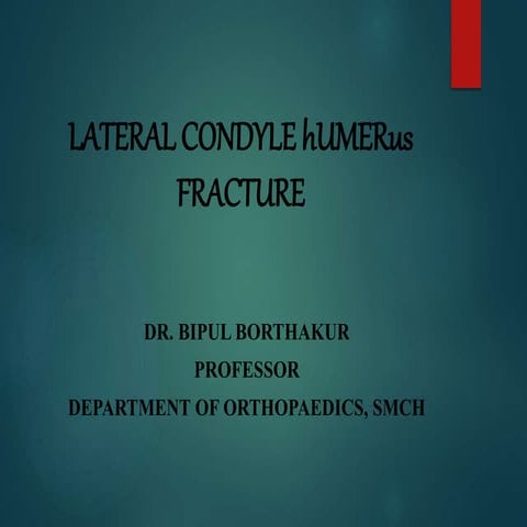 Lateral condyle fracture humerus