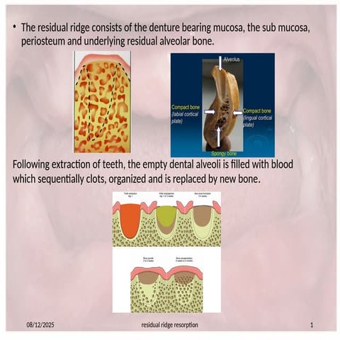 RESIDUAL RIDGE RESORPTION IN PROSTHODONTICS | PPTX