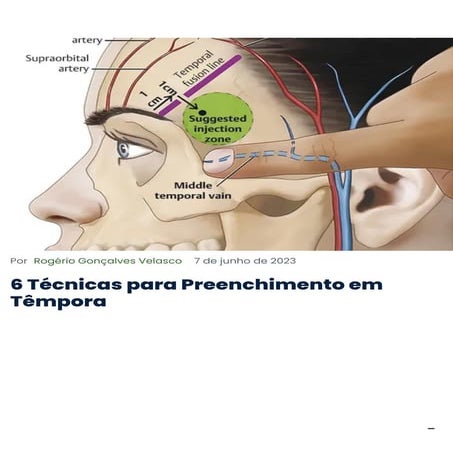 TECNICAS DIVERSAS DE PREENCHIMENTO EM TEMPORA | PDF