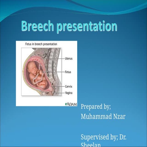 EXTERNAL CEPHALIC VERSION OBG NOTES .pptx