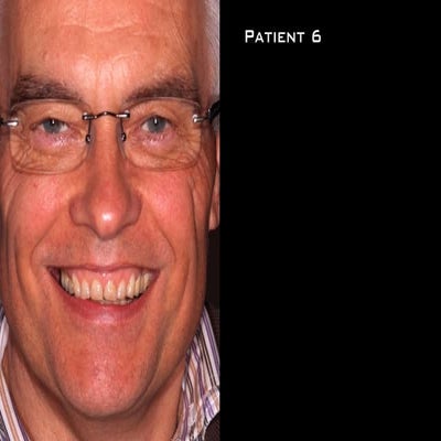 case presentation of patient of fixed prosthodontics department | PDF