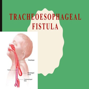 Tracheoesophageal fistula