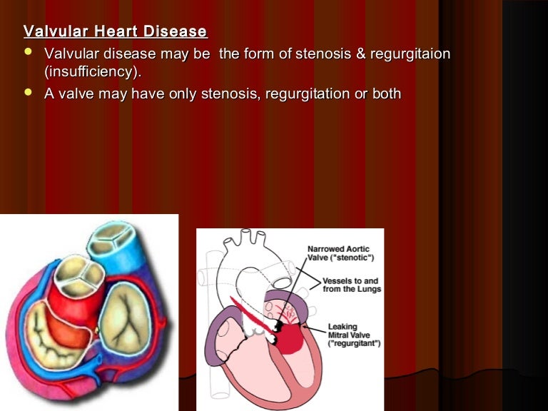 7.Valvular heart disease pathology