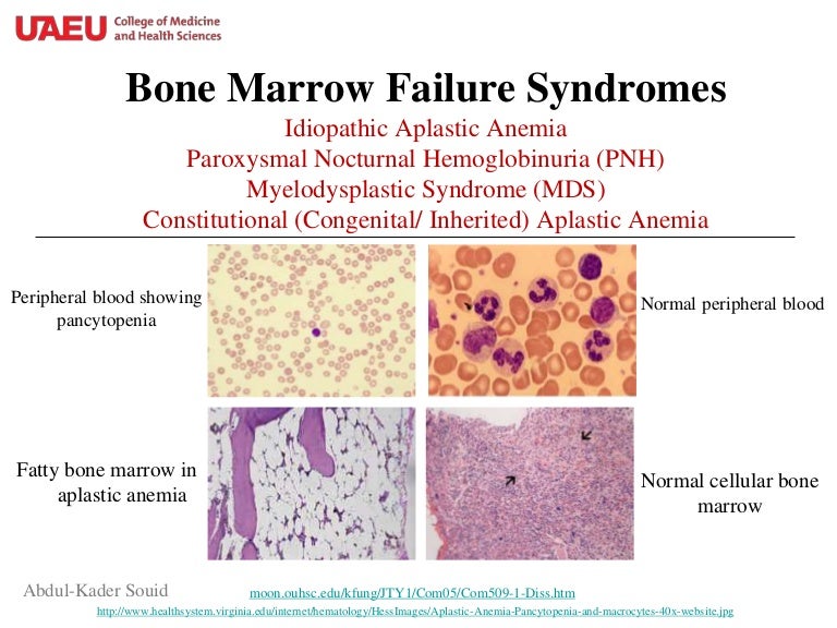 Bone marrow failure syndromes.ppt