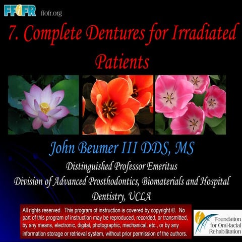 Complete Dentures for Irradiated Patients