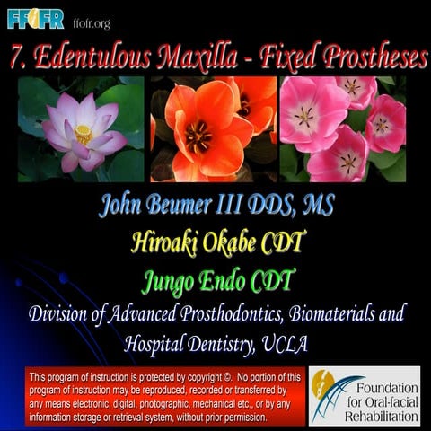 Edentulous Maxilla - Fixed Prostheses