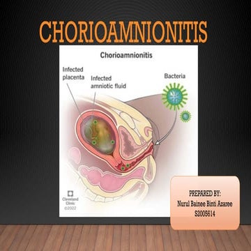 Comprehensive Case Study on Chorioamnionitis: Diagnosis, Management ...