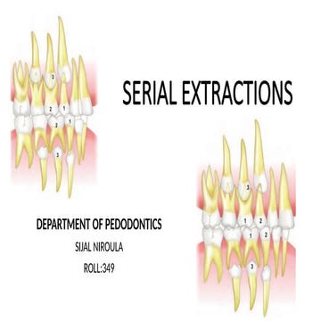 serial extraction | PPT