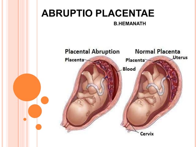 abruptio placenta original abruptio placentae