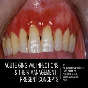 Acute Gingival Infections