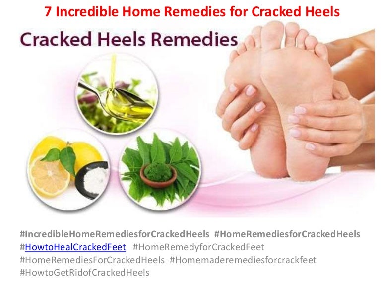 7 incredible home remedies for cracked heels