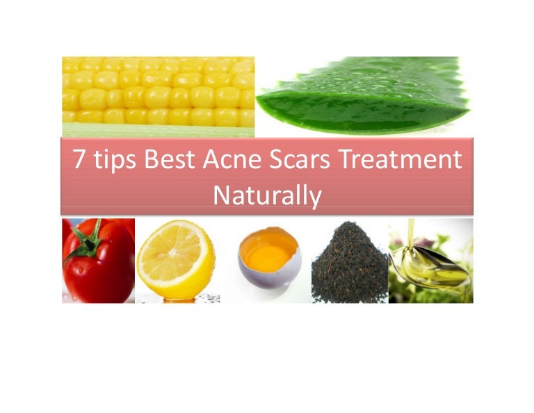 best remedy for acne marks