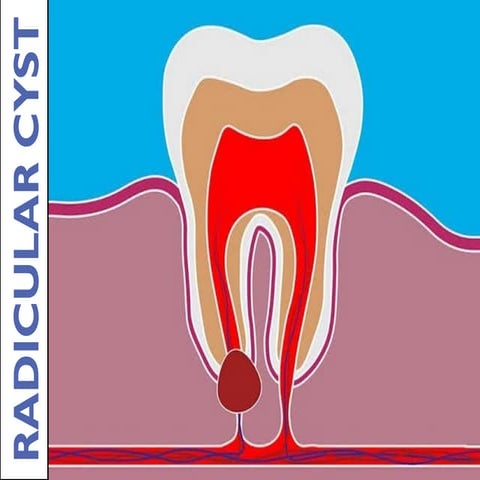 Comprehensive Overview of Radicular Cyst: Pathogenesis, Diagnosis, and ...
