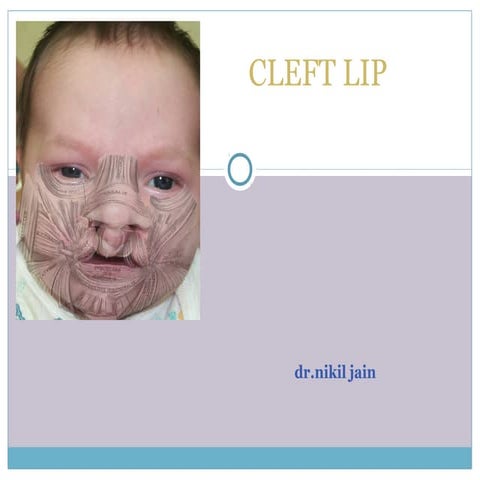 cleft lip