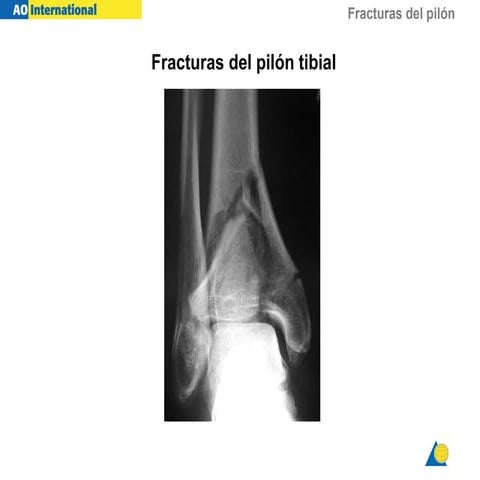 Fracturas del pilón tibial