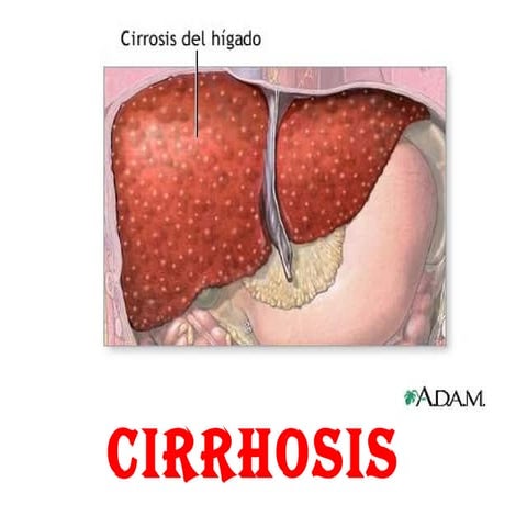 liver cirrhosis
