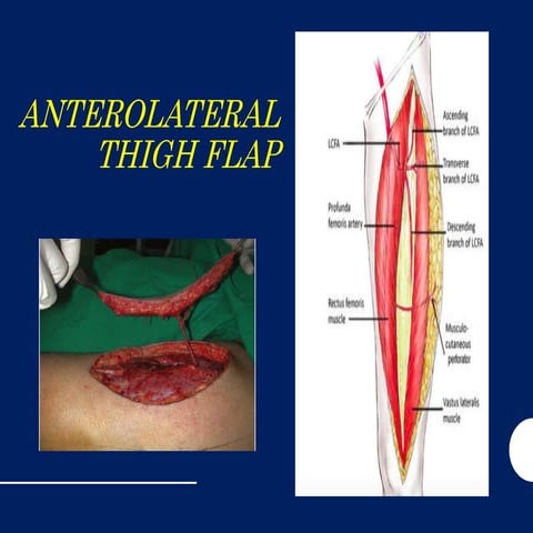 Antero Lateral thigh flap