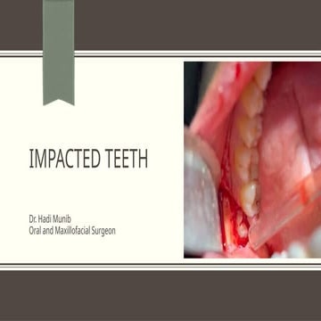 Management of Impacted Teeth and Post operative care | PPTX