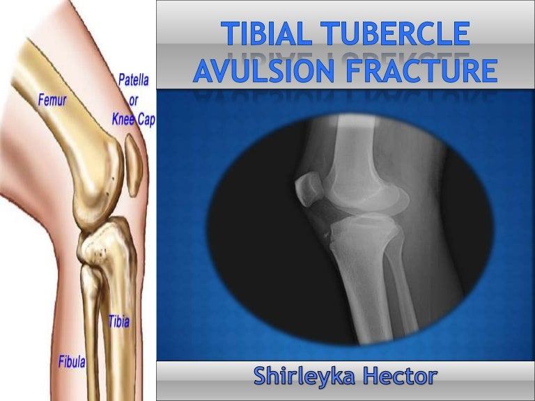 Tibial Tubercle Avulsion Fracture Powerpoint (1)