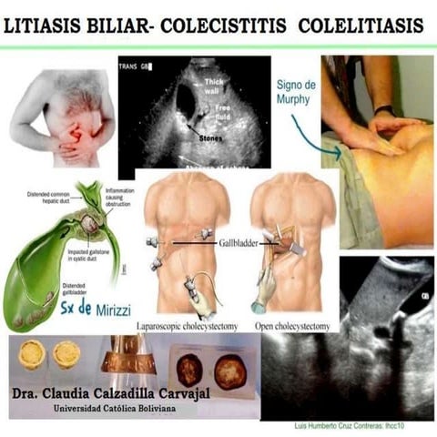 Colelitiasis y Colesistitis