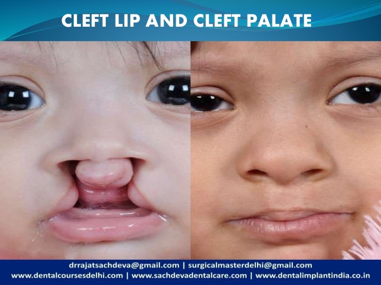 Cleft Lip Cleft Palate What Is A Cleft Lip Cleft Palate By Dr Raja