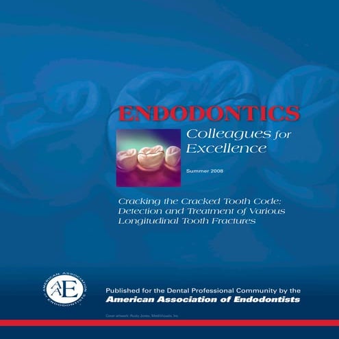 Cracked Teeth : management of longitudinal fractures