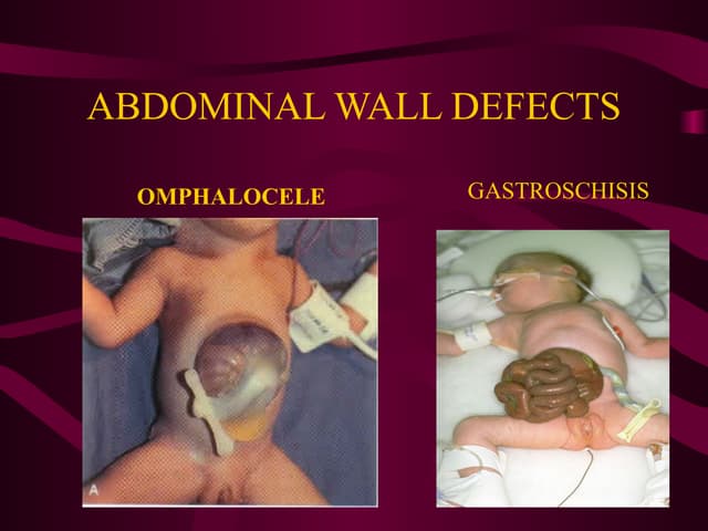 Abdominal wall defect | PPTX