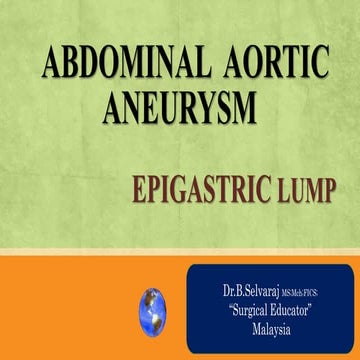 ABDOMINAL AORTIC ANEURYSM- EPIGASTRIC LUMPS- Abdominal Lumps.pptx