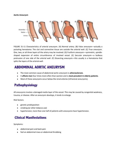 Anuerysm | PPT