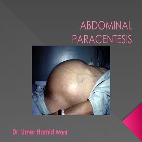 abdominal paracentesis-by Dr. Umer Hamid Wani.pptx