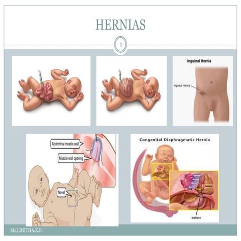 ABDOMINAL WALL DEFECTS.pptx