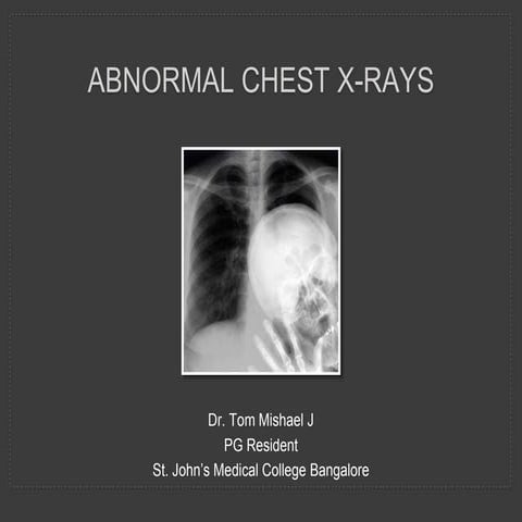 Abnormal Chest X rays
