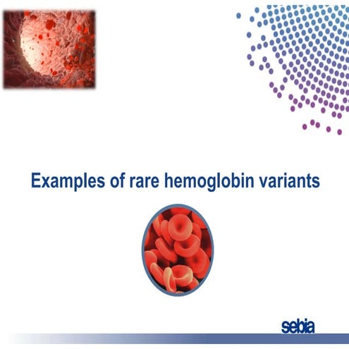 Rare Abnormal Hemoglobin Variants - Biochemistry