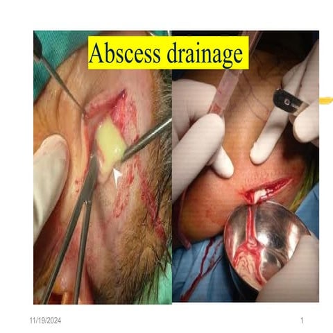 abscess &fracture.pptxhhhhhhhhhhhhhhhhhhhhhhh