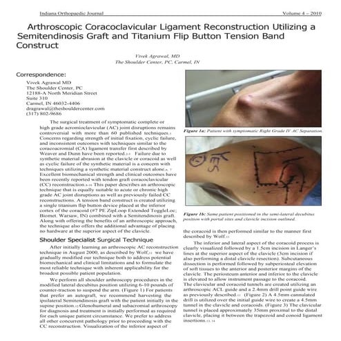 LARS ACJ Surgical Technique Corin Lennard Funk | PDF