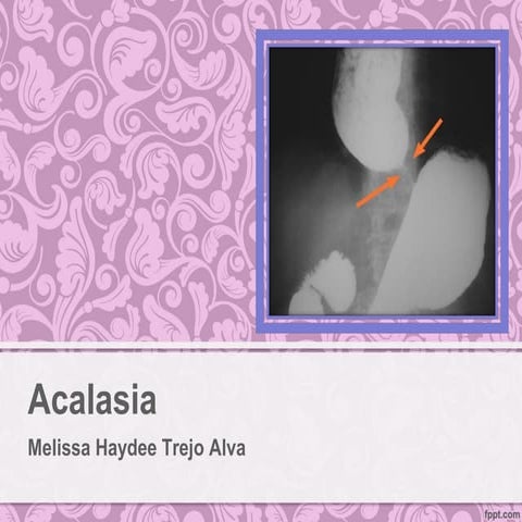 Acalasia