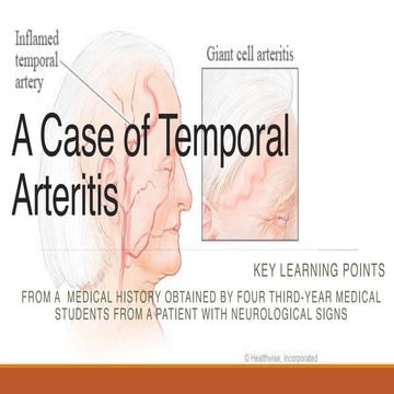 A case of temporal arteritis