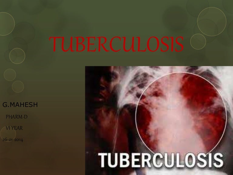 A case study on tuberculosis