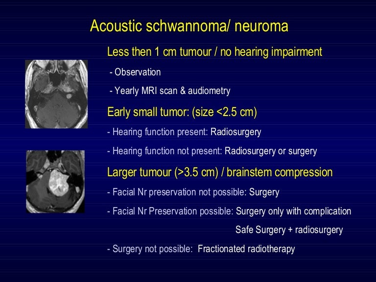 Acaustic schwannoma diagram of brain skull 