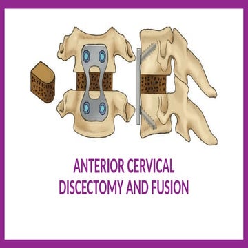 Comprehensive Guide to Anterior Cervical Discectomy and Fusion (ACDF ...