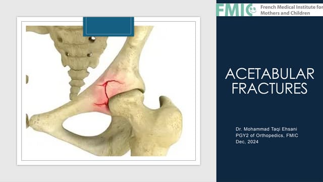 健康・医学 Fractures of the Acetabulum Fractures of the Acetabulum | Musculoskeletal Key