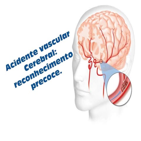 ACIDENTE_VASCULAR_CEREBRAL.pptx