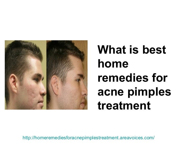 best home treatment for pimples